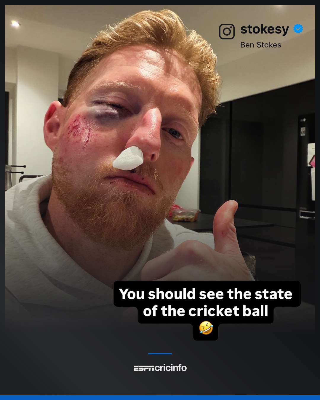 Ben Stokes suffers facial injury after being struck by ball